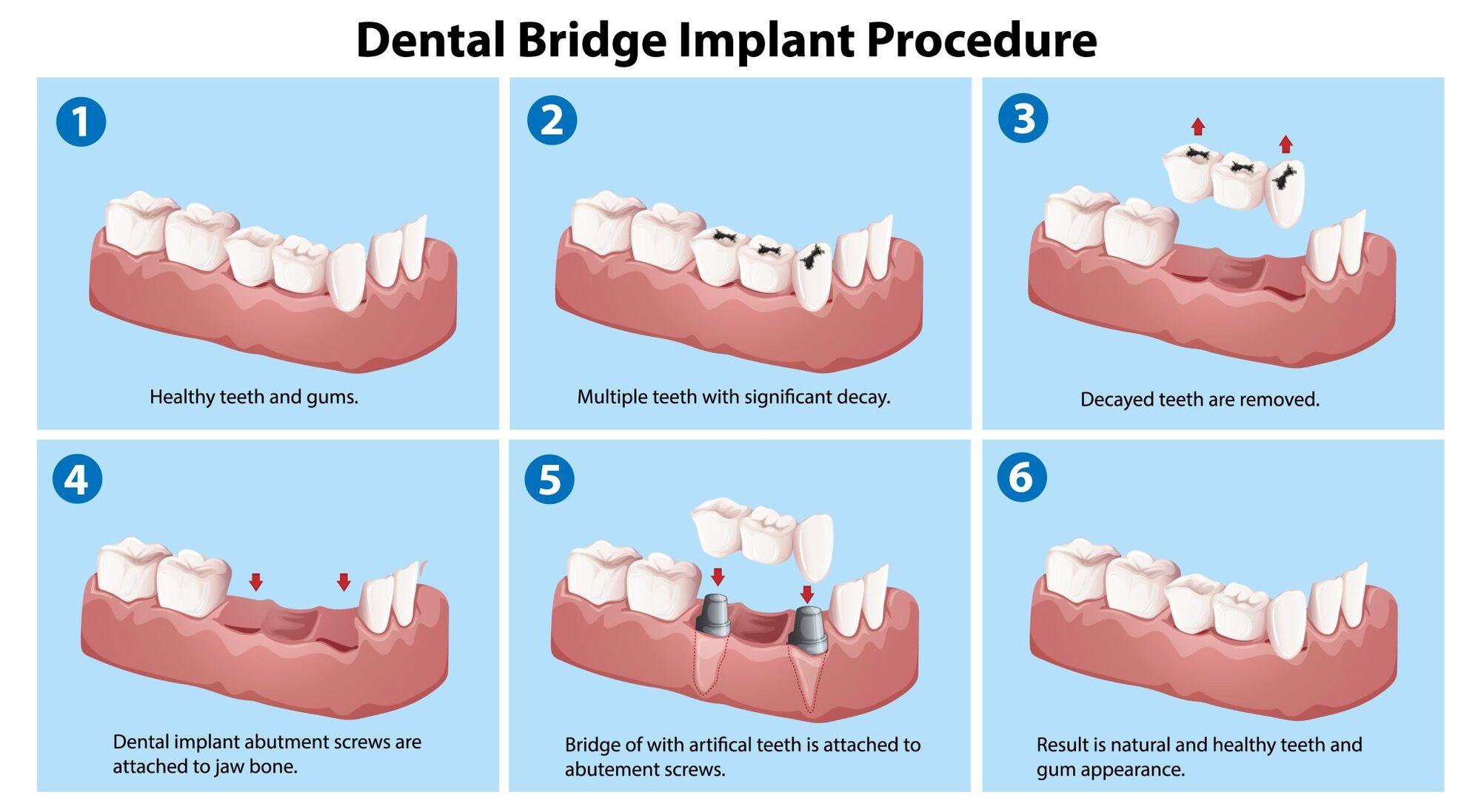 Dental bridge implant procedure