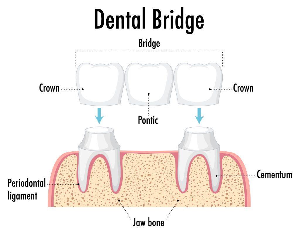 Infographic of human in dental bridge on white background