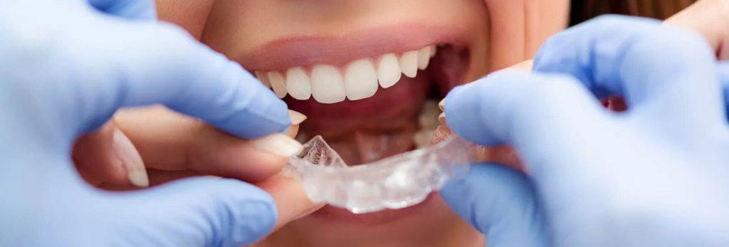 Invisalign Provider Highpoint | Gentle Care Family Dental Care