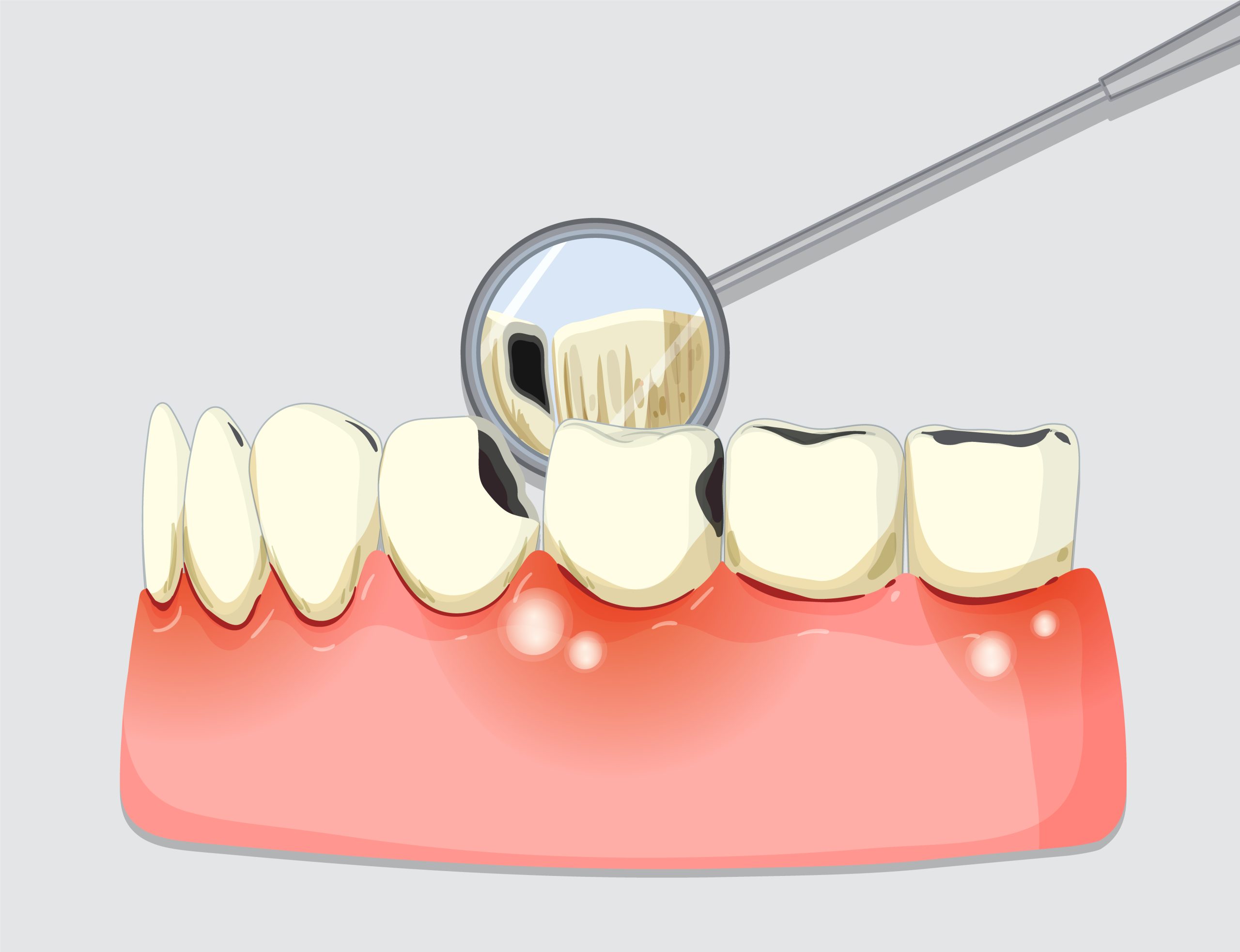 The Benefits of Choosing Dental Bridges at Gentle Care Family Dental