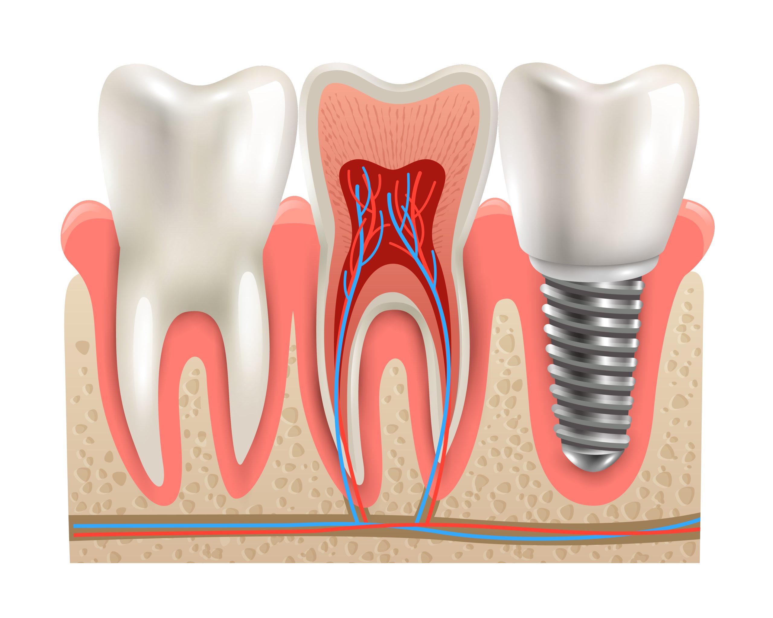 Understanding Dental Crowns in High Point: Restoration, Protection, and Smile Confidence