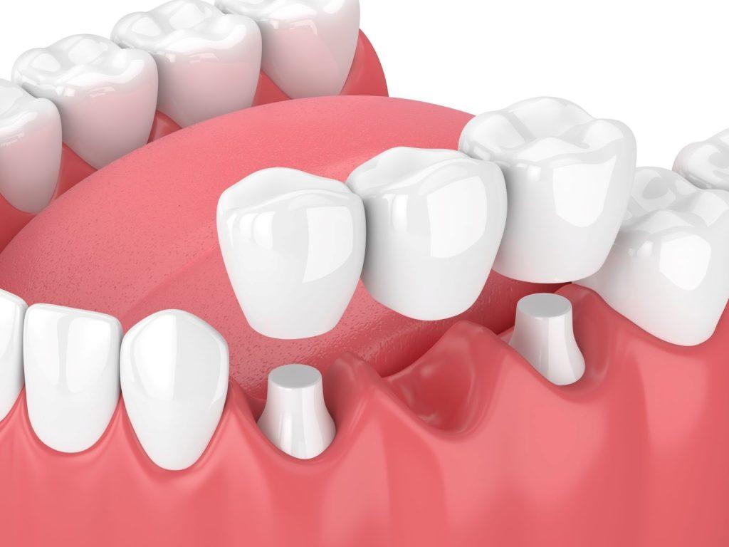 Dental Bridges in Highpoint | Gentle Family Dental Care 2026