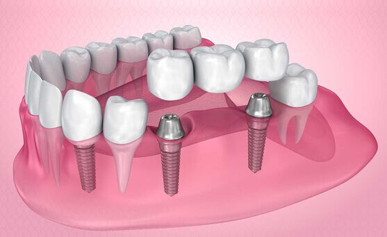 Dental Implants: Why They’re the Best Investment for Your Smile