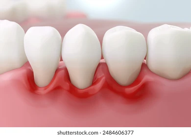 Periodontal Treatments in Highpoint: Restoring Gum Health & Saving Smiles