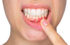 Gum Disease
