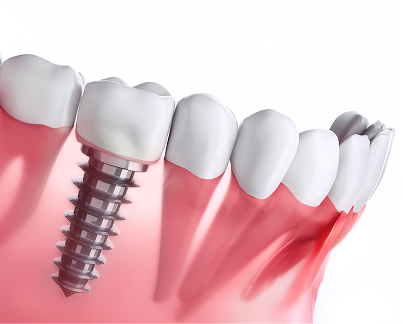 Implants