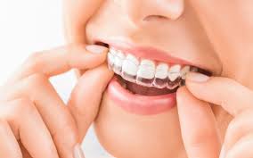 15 Facts About Invisalign You Need to Know