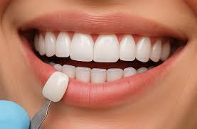 What is the Procedure for Porcelain Veneers?