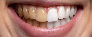 Teeth Whitening at Gentle Care: Bring Back Your Confident Smile