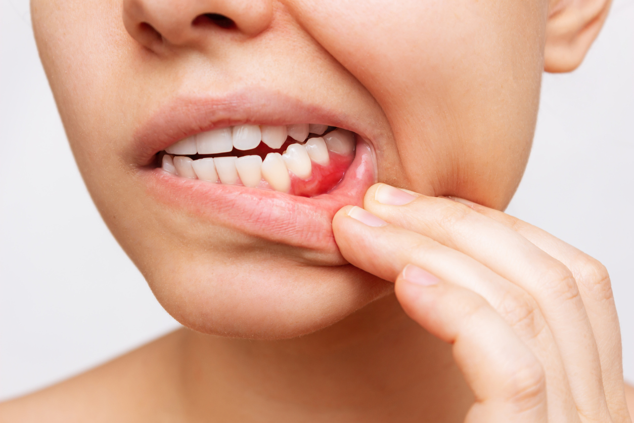 Tooth Infection Symptoms