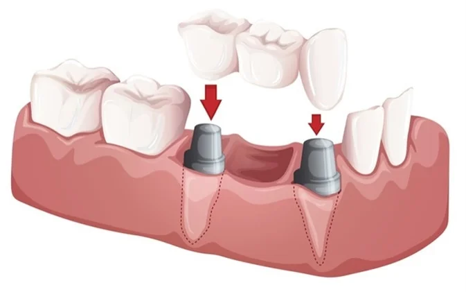 Rebuilding Smiles with Comfort: Dental Implants the Gentle Way at Gentle Care Dental Clinic