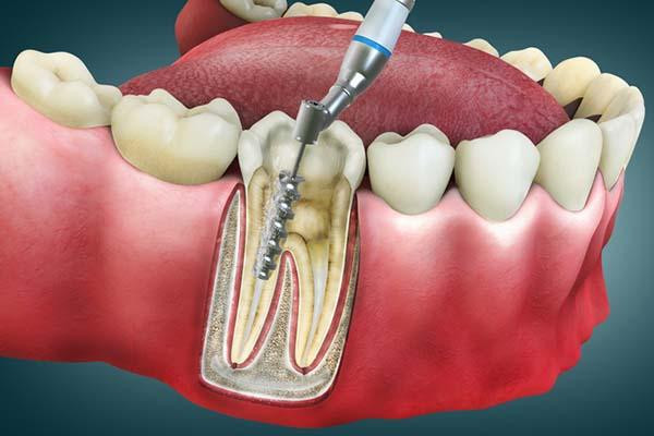 Root Canals at Gentle Care Family Dental: Preserving Your Smile with Care