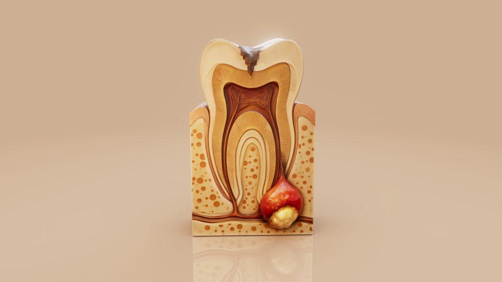 Root Canals in Highpoint | Gentle Care Family Dental Care