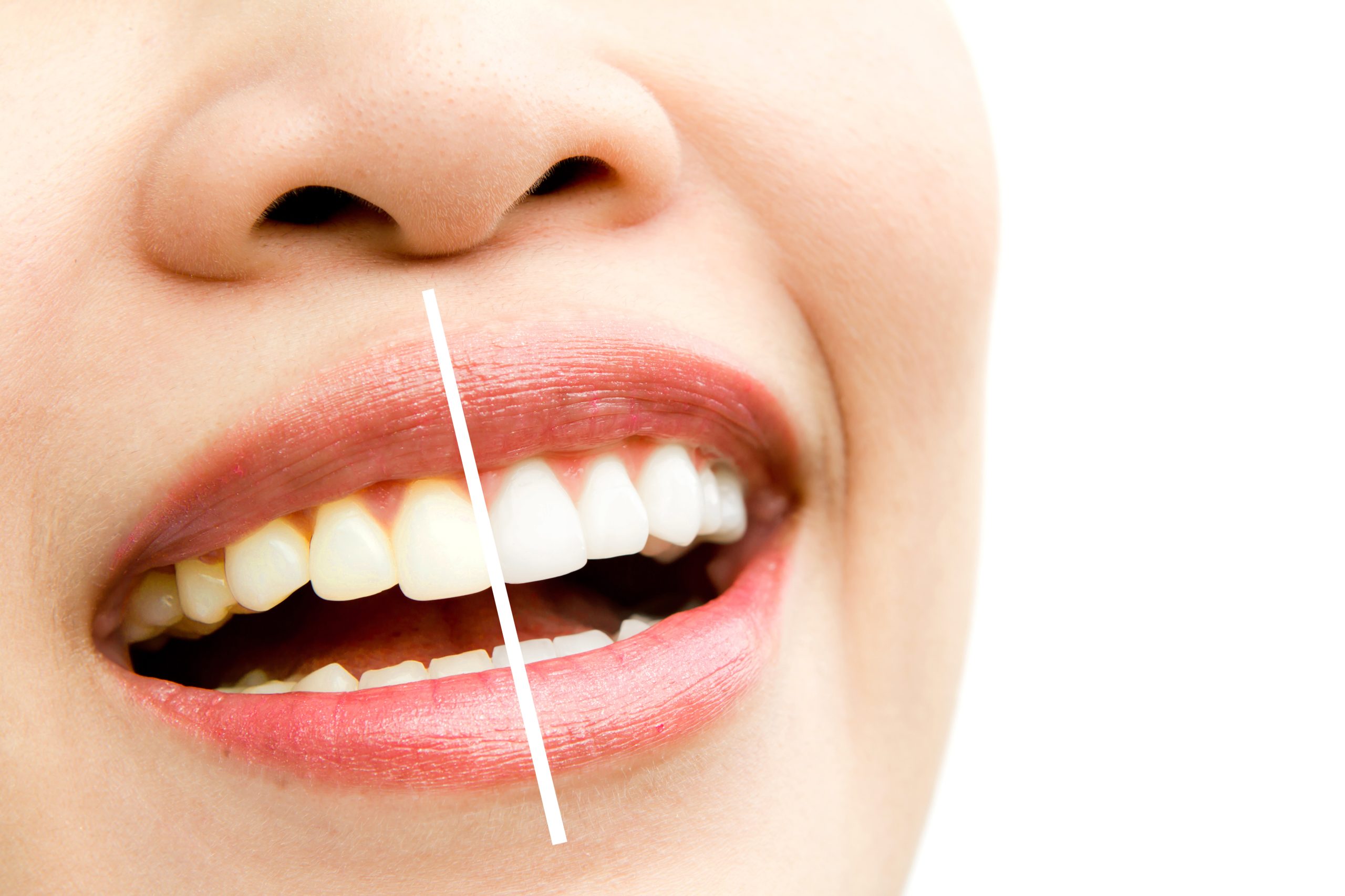 Teeth Whitening in Gentle Care: A Bright Smile Without the Stress