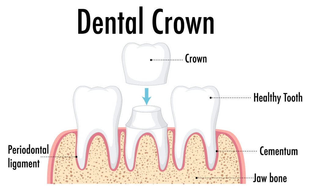 Dental Crowns High Point Cost: What Affects The Final Price?