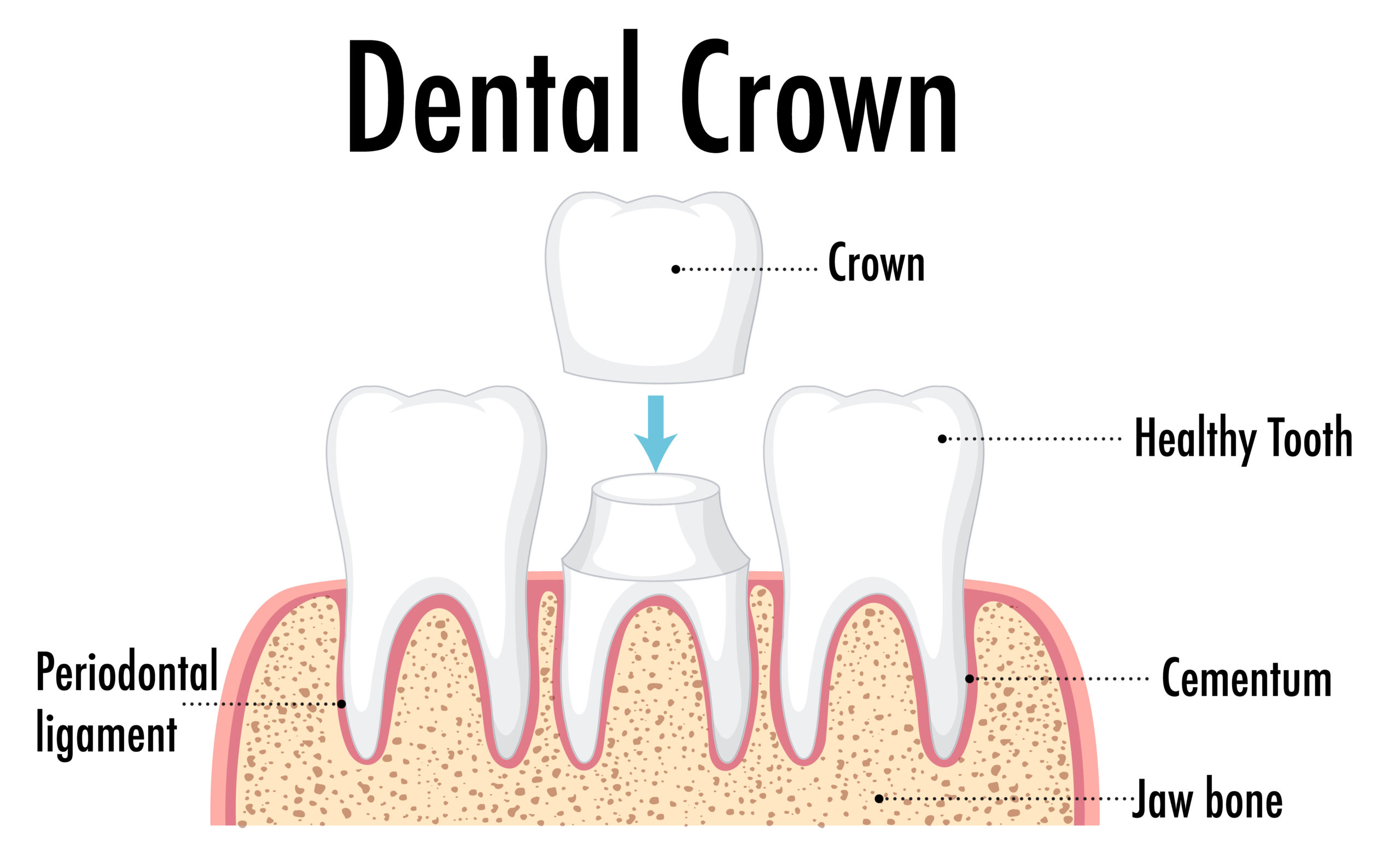 Dental Crowns High Point Cost: What Affects The Final Price?